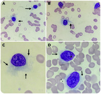 PCL mimicking vHCL: a rare morphological variant