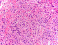 Erdheim-Chester Disease