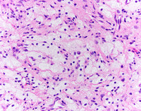 Erdheim-Chester Disease