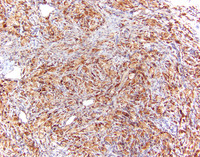 Erdheim-Chester Disease-CD68