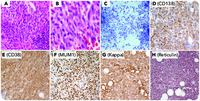 Spindle cell lesion in the bone marrow