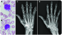 Multiple subperiosteal bone resorption in adult T-cell leukemia/lymphoma