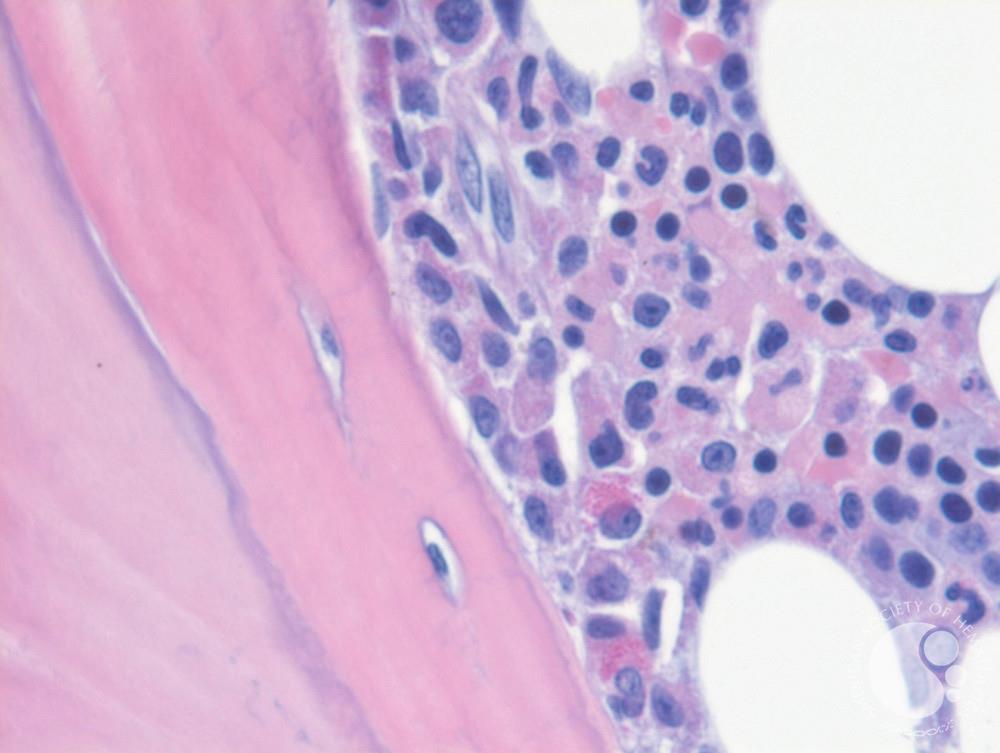Myelocytes in biopsy