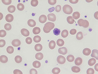 Giant platelets