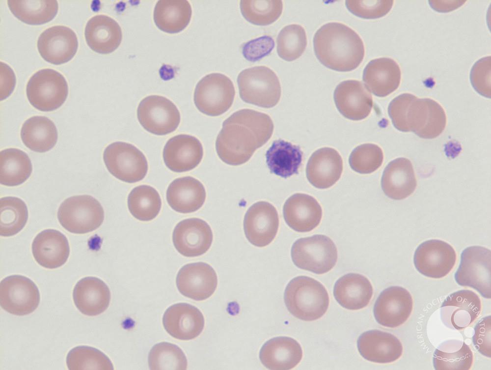 Blood-giant platelet