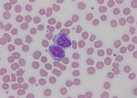 Circulating prolymphocytes in B cell prolymphocytic leukemia (B-PLL)