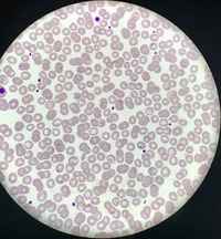 Babesia parasites on peripheral blood smear 1
