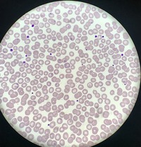 Babesia parasites on peripheral blood smear 2