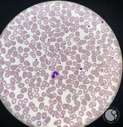 Babesia parasites on peripheral blood smear 3