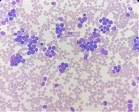 T Lymphoblastic Lymphoma/Leukemia mimicking Burkitt's lymphoma 1