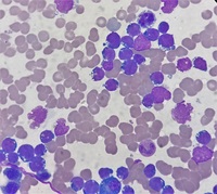 T Lymphoblastic Lymphoma/Leukemia mimicking Burkitt's lymphoma 2