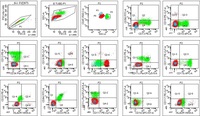 T Lymphoblastic Lymphoma/Leukemia mimicking Burkitt's lymphoma 3