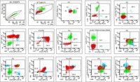 T Lymphoblastic Lymphoma/Leukemia mimicking Burkitt's lymphoma 4