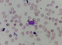 Circulating prolymphocytes cell in peripheral blood sample 2