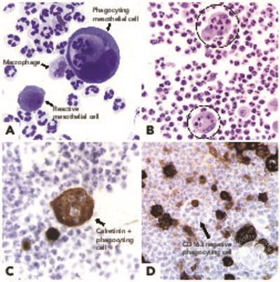 Differentiation of mesothelial cells into macrophage phagocytic cells in a patient with clinical sepsis