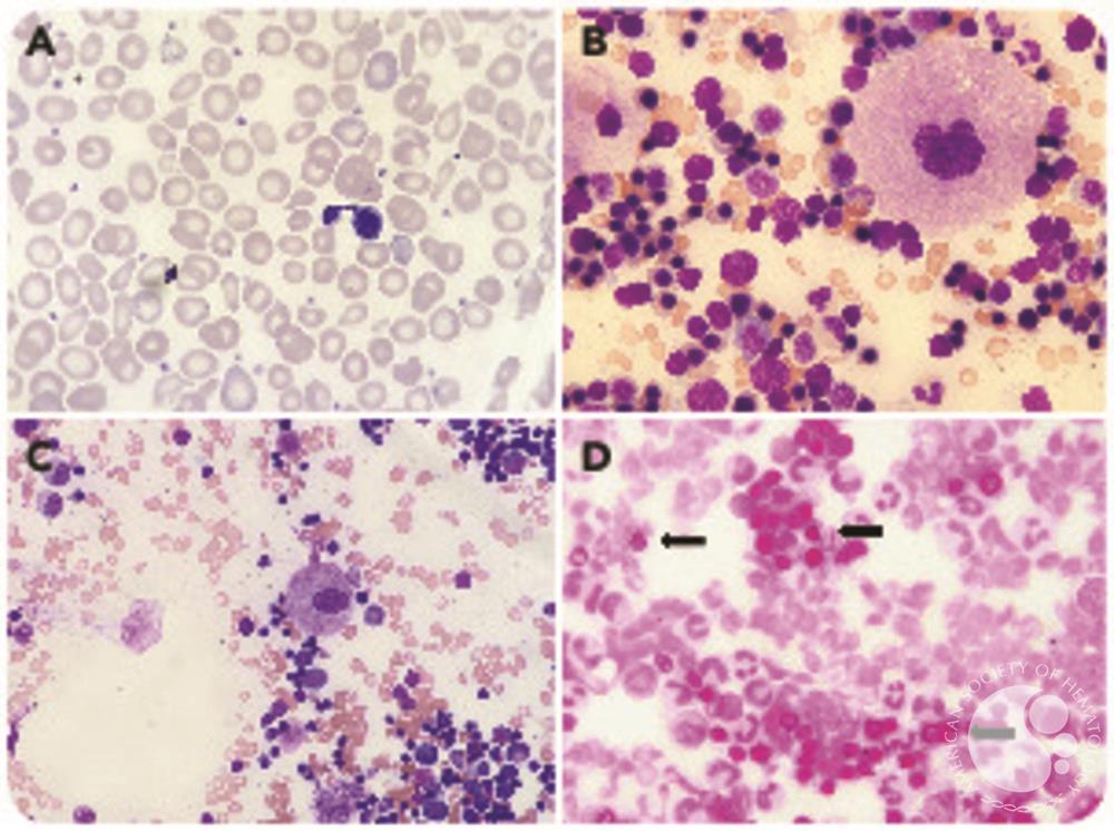 Bone marrow histopathologic findings in SIFD syndrome: beyond the erythroid lineage