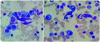 An unexpected association of hematologic malignancies