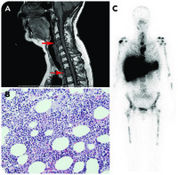 Patchy hematopoiesis mimicking bone metastasis