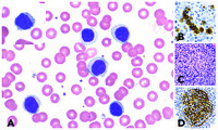 splenic marginal zone lymphoma