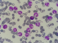 Chronic Myeloid Leukemia presentation in peripheral blood 1