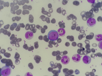Chronic Myeloid Leukemia presentation in peripheral blood 2