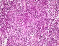 NKcell-enteropathyHE