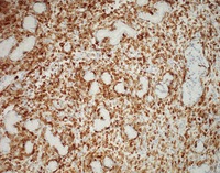 NK-cell enteropathy-CD2