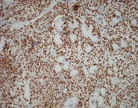 NK-cell enteropathy-CD3