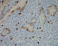 NKcell-enteropathyCD5