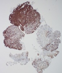 NK-cell enteropathy-CD56