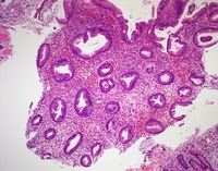 NKcell-enteropathyHE