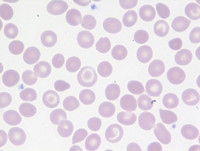 Beta-thalassemia trait-Blood