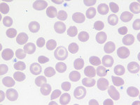 beta-thalassemia-trait-blood