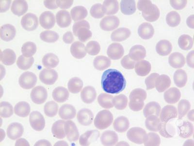 Beta-thalassemia trait-Blood