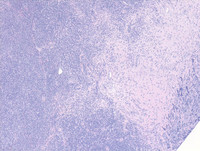 Anaplastic large cell lymphoma, ALK-negative