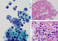 Breast-implant associated Anaplastic large cell lymphoma