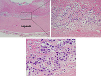 BIA-ALCL