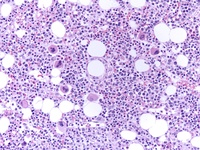 Normal hematopoiesis and ring granuloma