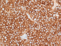 Myeloma-with-Cyclin-D1