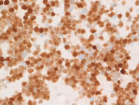Myeloma-with-Cyclin-D1