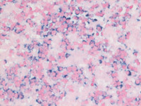 Myeloma with Cyclin D1