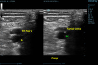 popliteal vein ultrasound