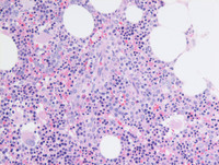 MDS-RS-MLD-Core biopsy