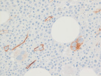 MDS-RS-MLD-CD34 stain