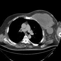 DLBCL/DHL-CT Chest 1