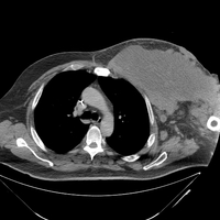 DLBCL/DHL-CT Chest 2