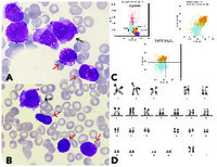 B & B: basophils and bleeding, an atypical case of acute promyelocytic leukemia