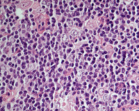 NLPHL with progression