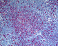 NLPHL-with-progression