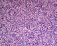 NLPHL-with-progression